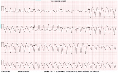 ECG showing Ventricular Tachycardia.