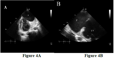 Repeat echocardiogram 4 weeks after admission from apical two-chamber