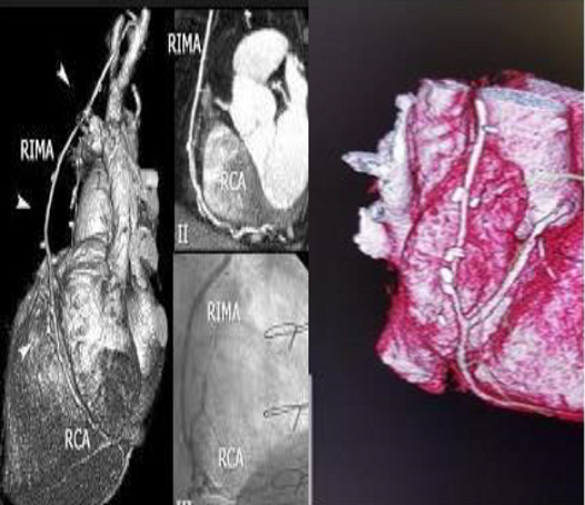 Right internal mammary artery (RIMA) graft evaluation.