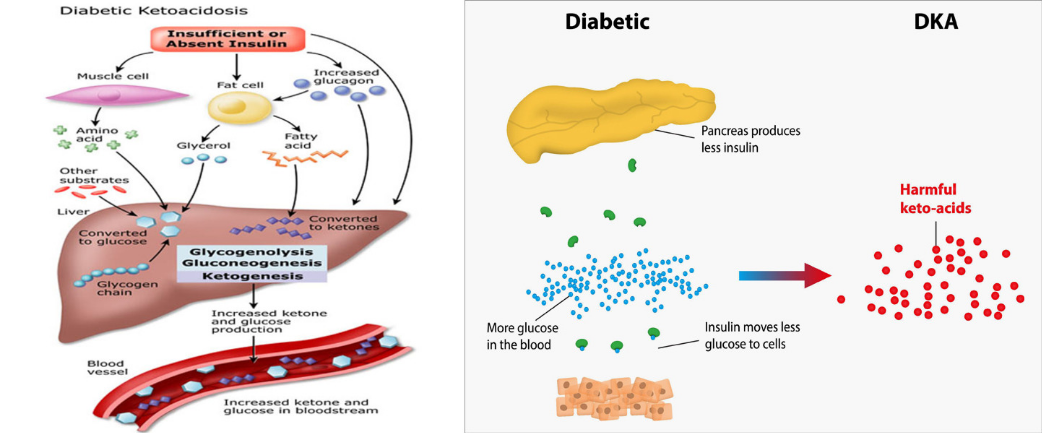 Journal of Obesity and Diabetes (ISSN: 2638-812X Diabetic ketoacidosis