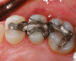 Journals on Amalgam Fillings | Dentistry research articles | Dental Research and Management