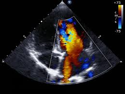 Echocardiology | Clinical Cardiology and Cardiovascular Medicine | cardiac  echo | Doppler ultrasound